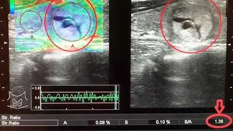 УЗИ Узел в щитовидной железе. Эластография. Thyroid node. Sonoelastography.